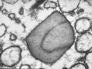 M,62y. | crystalline inclusion in endoplasmic reticulum - bone marrow, plasmocytoma